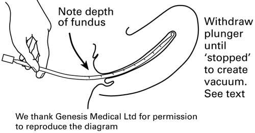 MUESTREO ENDOMETRIAL