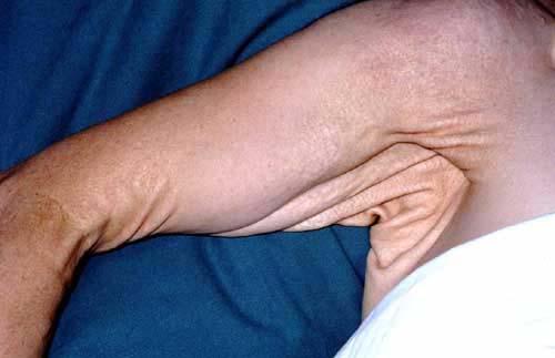 PSEUDOXANTOMA ELÁSTICO