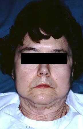 PSEUDOXANTOMA ELÁSTICO