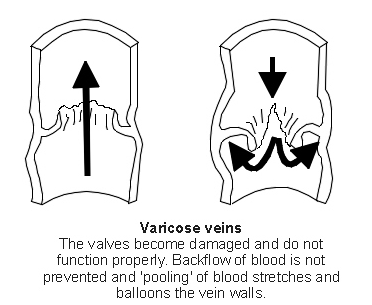Vena varicosa