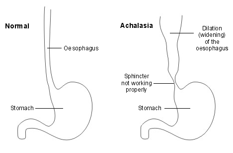 acalasia