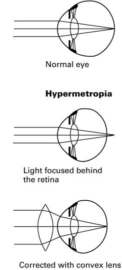 Hipermetropía hipermetropía