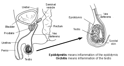 Testículos con explicación de epididimitis y orquitis