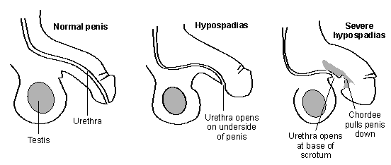 Hipospadias
