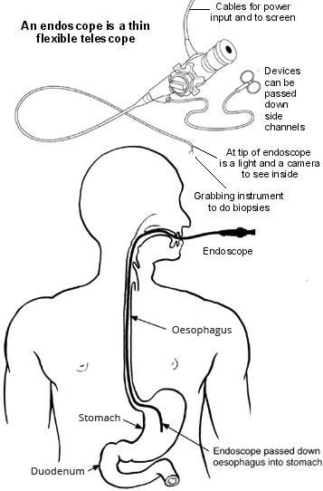Gastroscopia