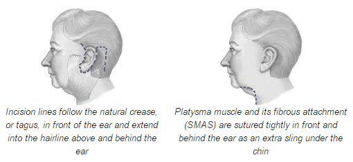 Lifting facial