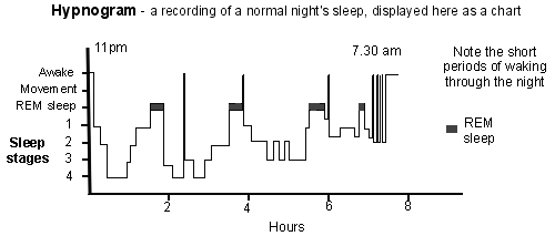 Hipnograma: gráfico de una noche de sueño normal