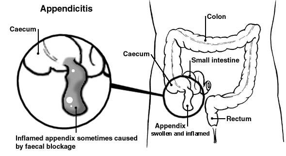 Diagrama del intestino que muestra un apéndice inflamado