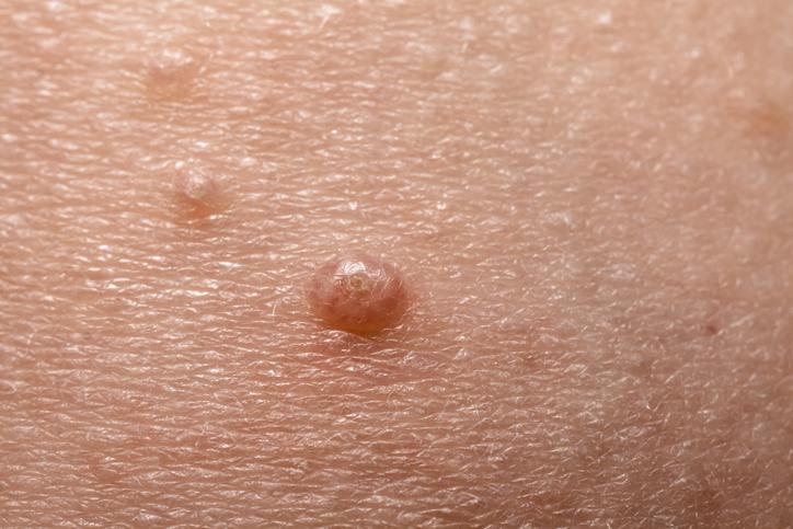 Molusco contagioso