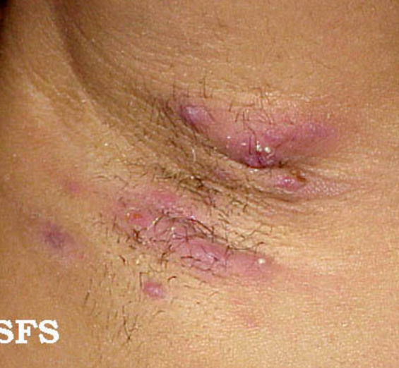 hidradenitis supurativa