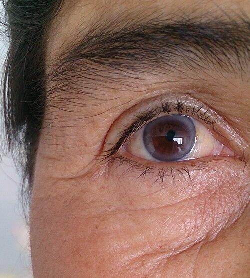 Foto de Arcus senilis