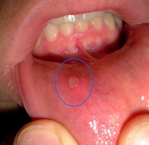 Photo of a mouth ulcer