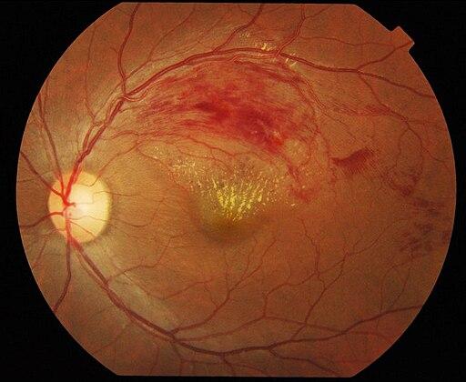 Oclusiones venosas retinianas