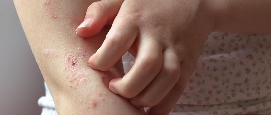 Picor del eczema