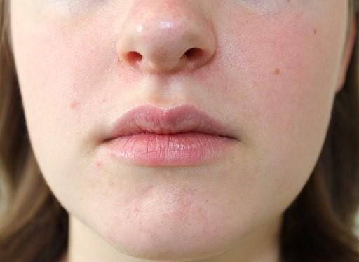 Dermatitis perioral