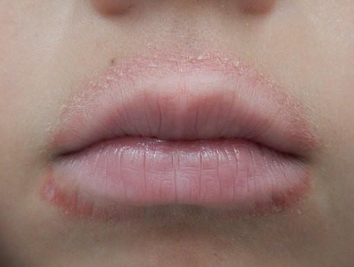 Dermatitis labial