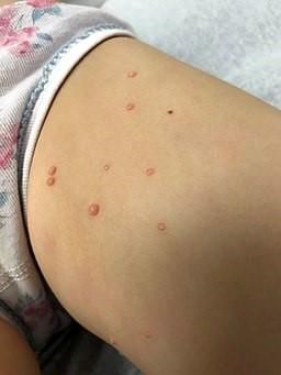 Molusco contagioso