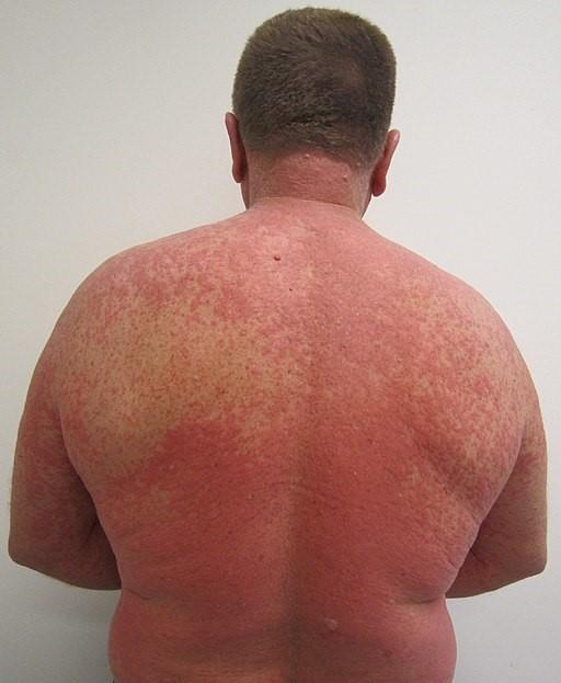 Reacción al fármaco