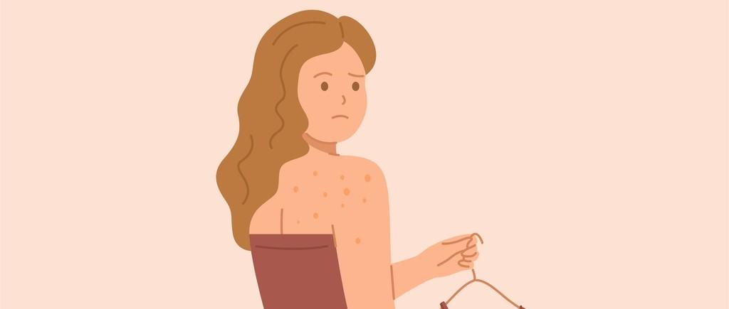 8 causas del acné en la espalda