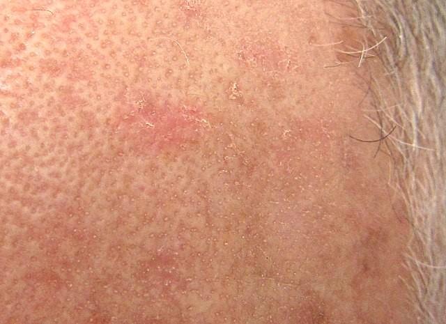 Vista de cerca de una queratosis actínica