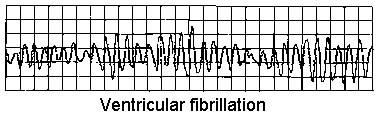 FIBRILACIÓN VENTRICULAR
