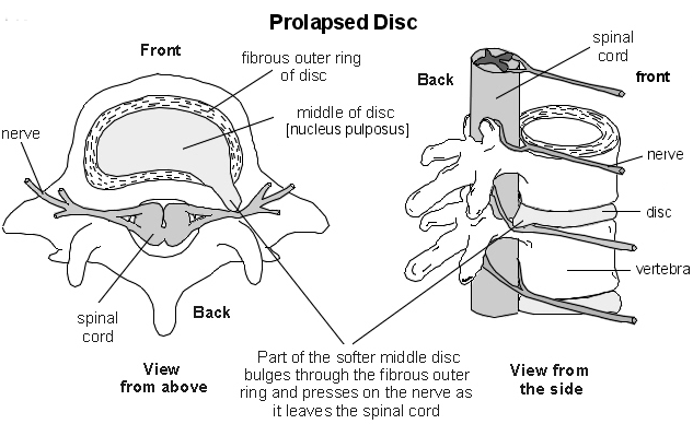 Prolapso discal