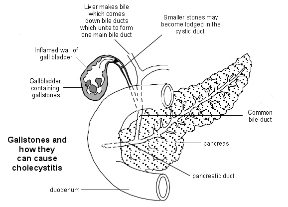 Cálculos biliares causantes de colecistitis