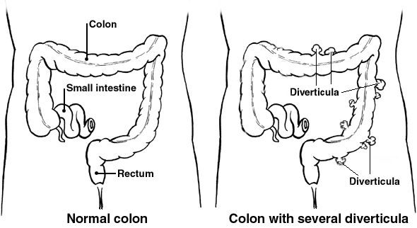 Divertículos