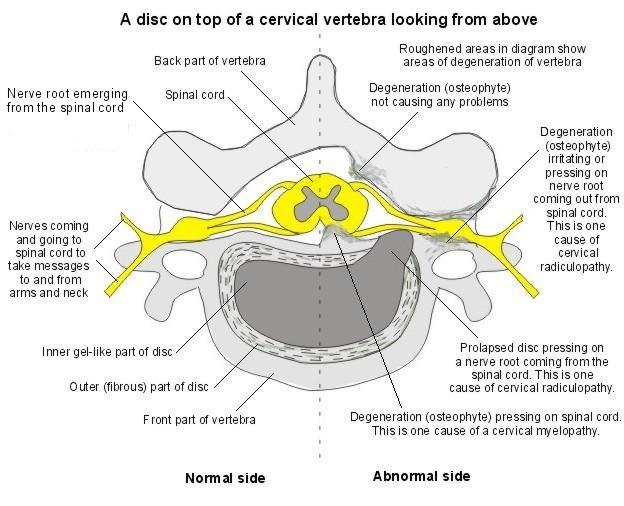 Vértebra cervical (Beverley Kenny)