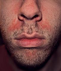 Dermatitis seborreica en la cara