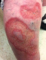 Necrobiosis lipoidea