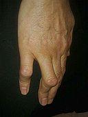 Deformidad del boutonniere