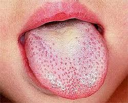 Lengua escarlatiniforme - manchas blancas en la lengua