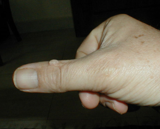 Common wart on thumb