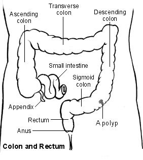 Intestino grueso con pólipo