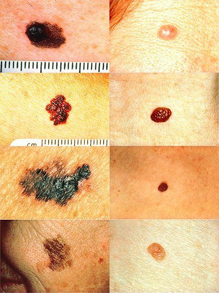 Melanoma frente a lunar normal Regla ABCD