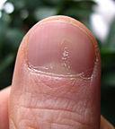 Psoriatic nail