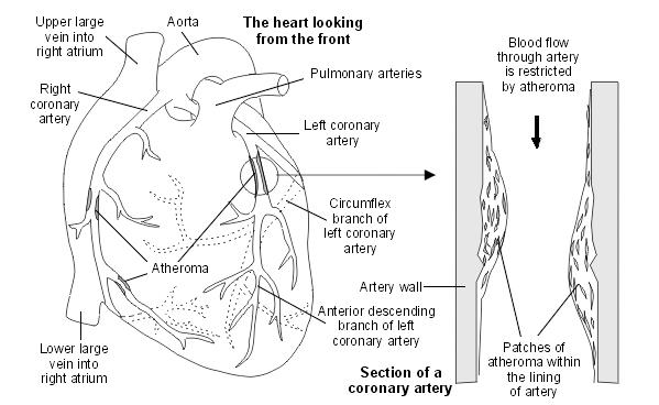 Corazón con ateroma