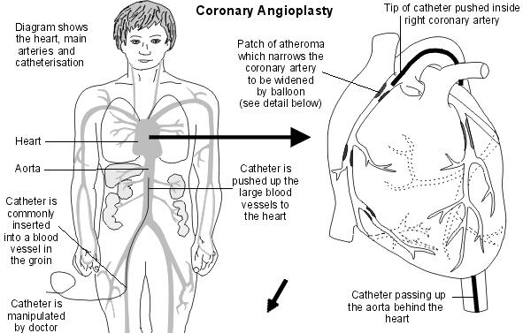 Angioplastia coronaria