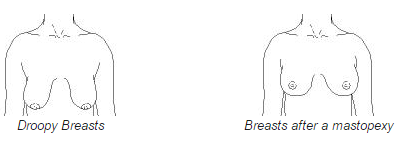 Pechos caídos antes y después de la mastopexia