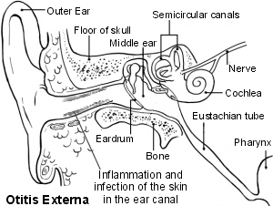 Otitis externa