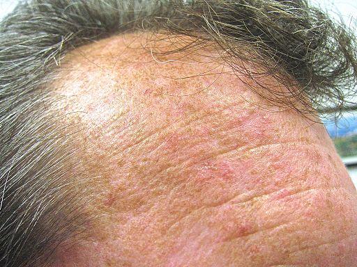 Queratosis actínica en la frente