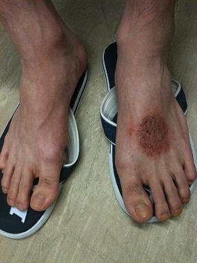 Liquen simple en el dorso del pie de un hombre joven