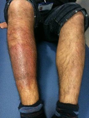 Liquen simple en la espinilla de un joven