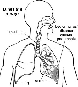 Pulmones y vías respiratorias - Legionelosis