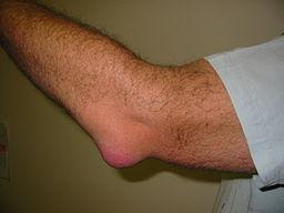 Bursitis del olécranon Codo
