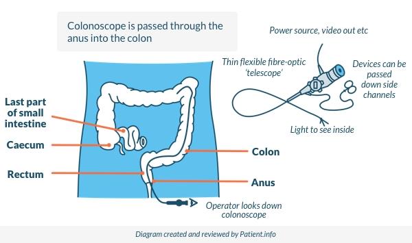 Colonoscopia Nuevo