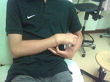 Colles fracture externally. Not an X-ray