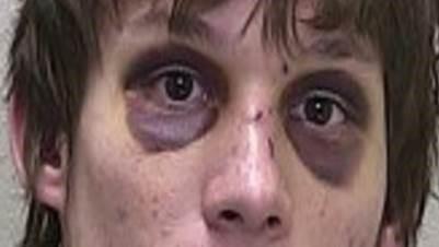 Equimosis periorbitaria bilateral