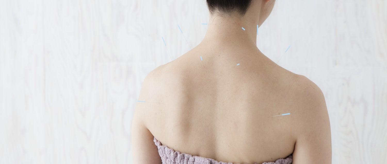 Acupuntura